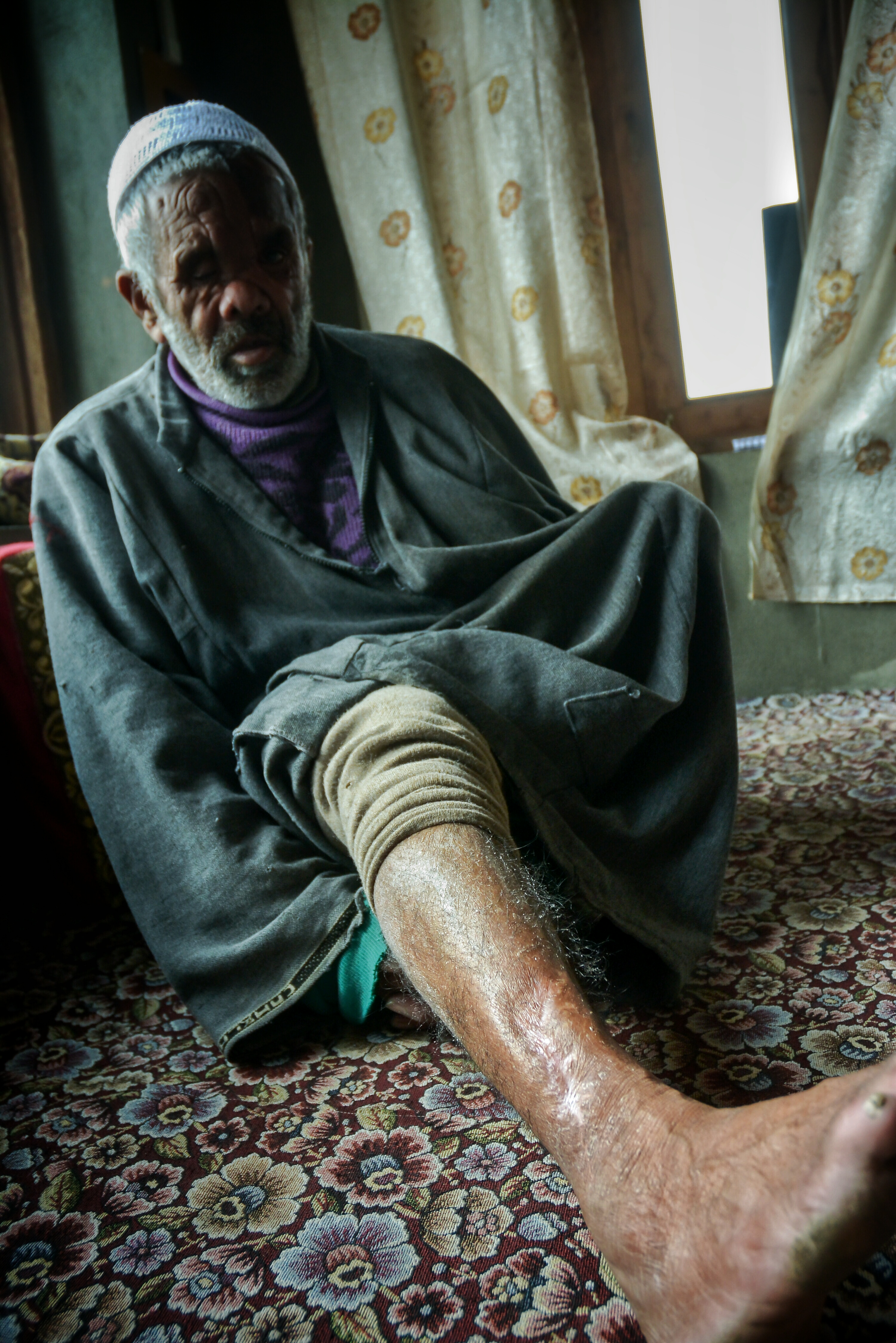 Abdul Rehman Reshi, who was attacked by a black bear, shows the injuries to his face and leg. Credit: Shams Ul Haq Qari