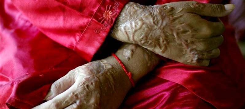 long road to justice for acid attack survivors despite stringent laws