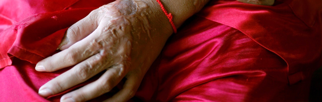 india needs to seriously address its acid attack problem