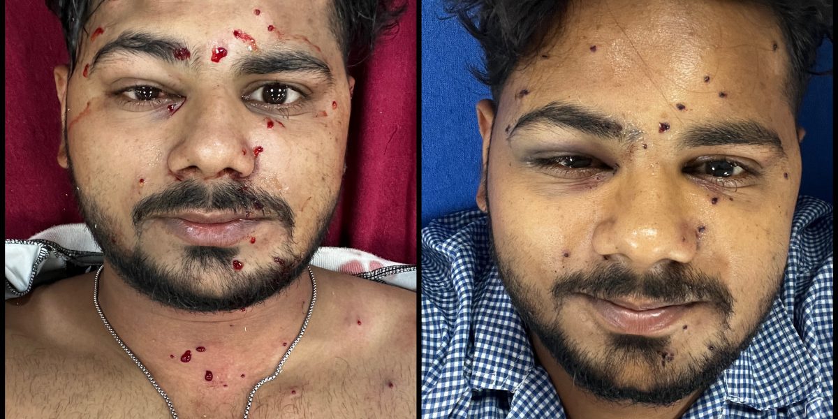 Two Pellet Firing Victims Move Supreme Court Seeking Ban on Metallic Pellet Guns Against Civilians